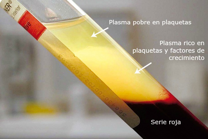 Tubo de ensayo con plasma pobre en plaquetas y plasma rico en plaquetas